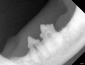 The lower left molar was missing on visual exam, but an infected root fragment was found on this radiograph.                   
